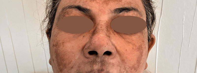 Pigmentproblemen