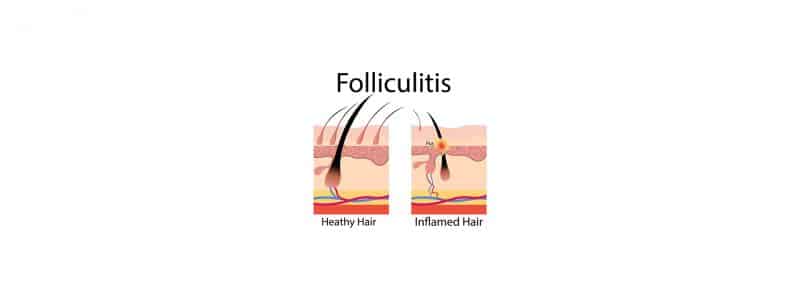 Close-up van huid met folliculitis om het verschil met acne te tonen