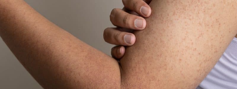 Keratosis pilaris op bovenarm