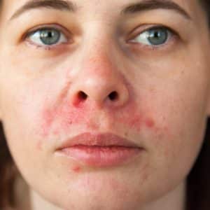 Persoon met dermatitis op het gezicht
