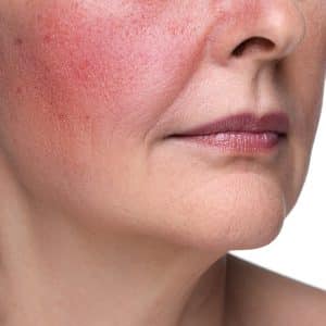 Zijaanzicht van gezicht met rosacea