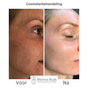 Cosmelan behandeling voor en na foto