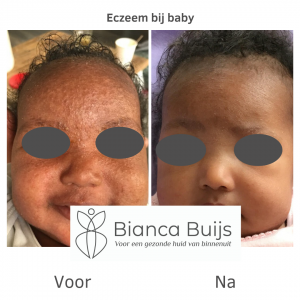 Eczeem bij baby donkere huid voor en na foto