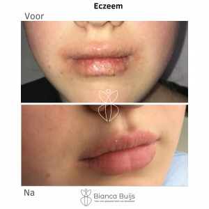 Eczeem lippen Voor en na foto