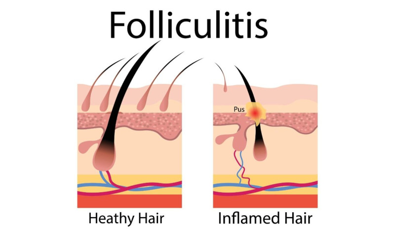 Gistpuistjes of Folliculitis is geen acne