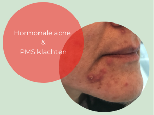 Hormonale acne op de kin en PMS klachten