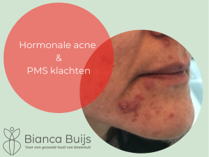 Hormonale acne op kin en PMS klachten