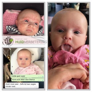 NEURODERMATITIS BABY VOOR EN NA FOTO