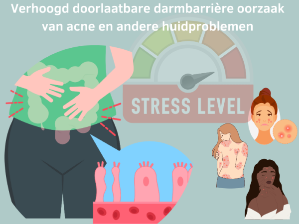 Verhoogd doorlaatbare darmbarrière oorzaak van acne en andere huidproblemen