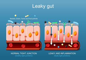 Verhoogd doorlaatbare darmbarrière oorzaak van acne en andere huidproblemen