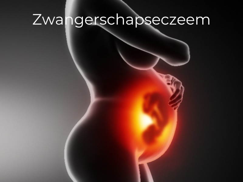 Zwangere vrouw met eczeem