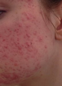 Acne littekens rode vlekjes na puistjes